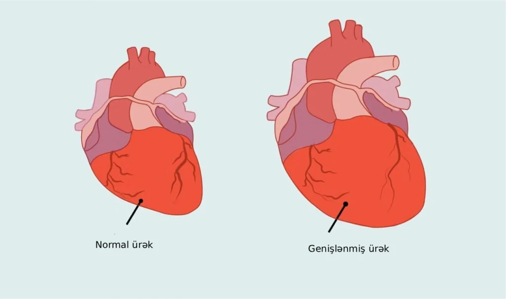 ürək genişlənməsi əlamətləri