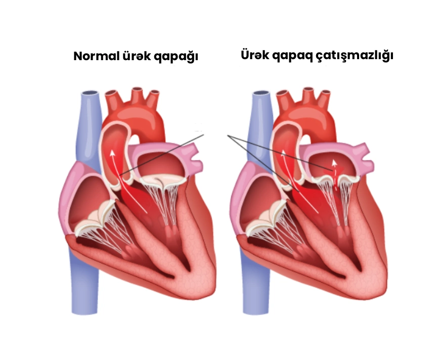 ürək qapaq çatışmazlığı